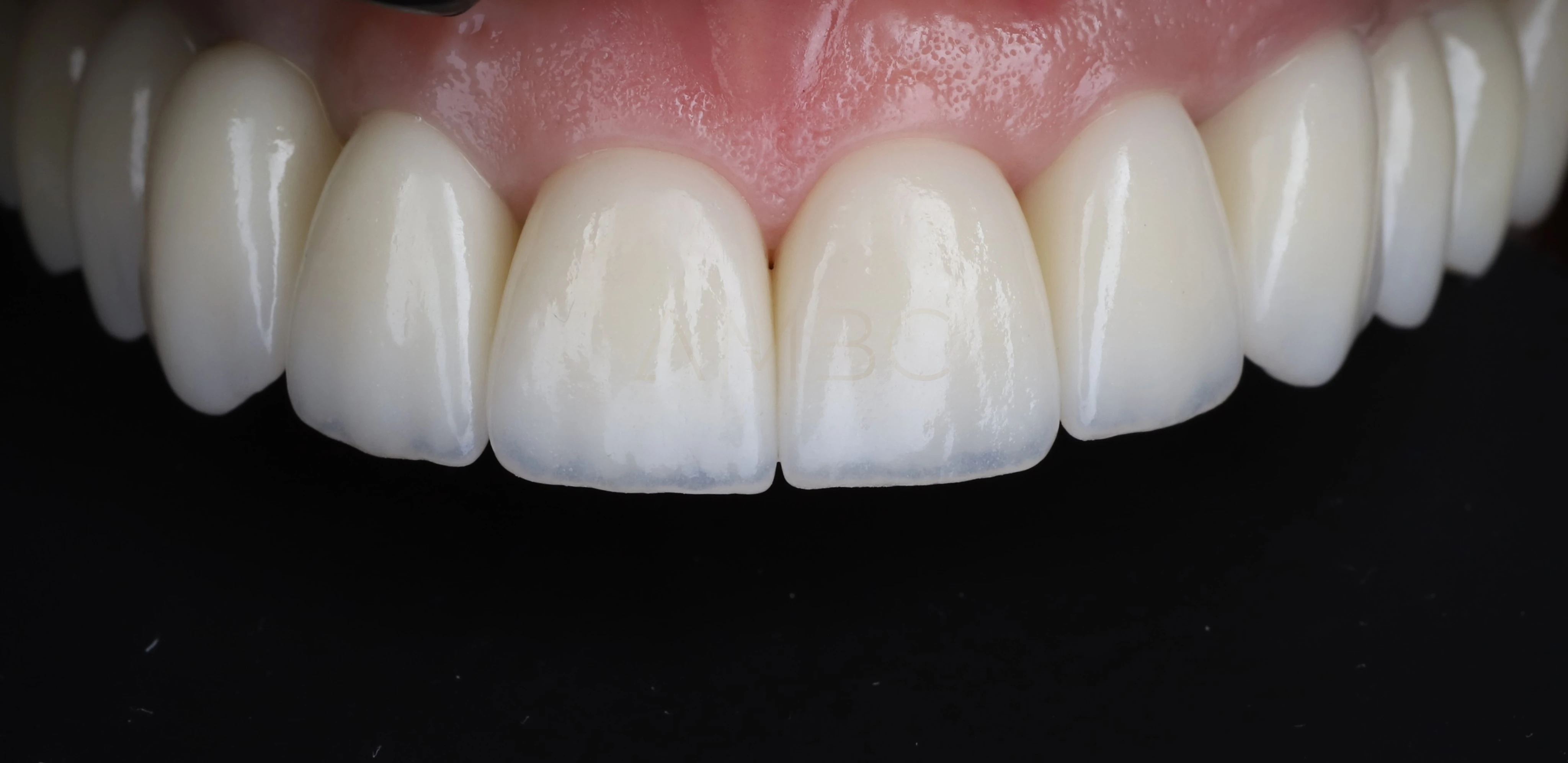 Протезирование зубов