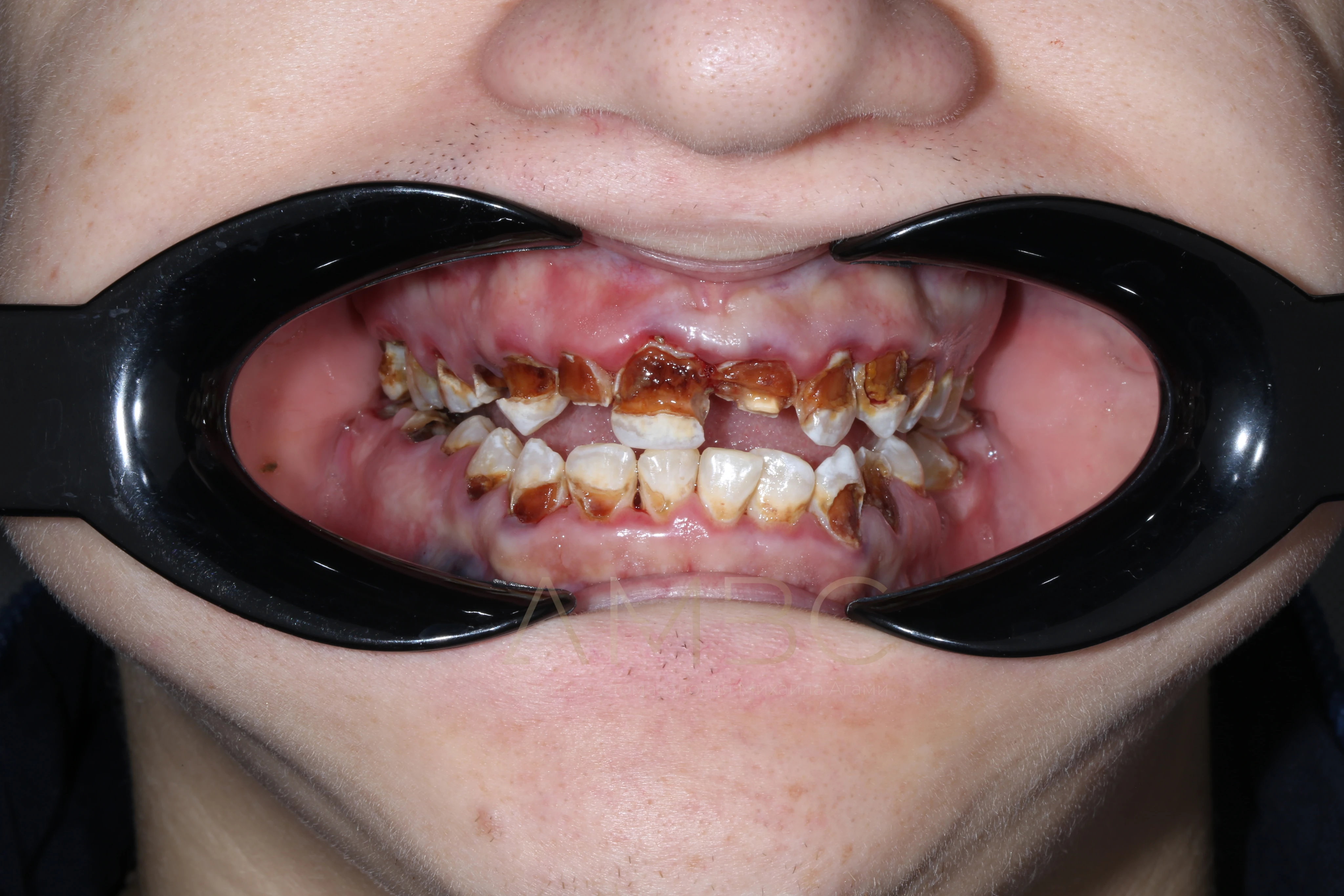 Имплантация и протезирование Имплантация и протезирование