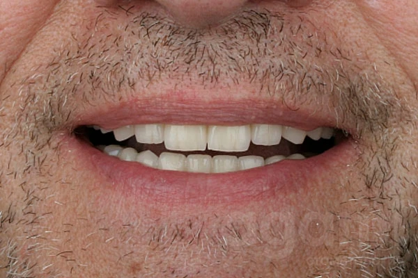 Реставрация зоны улыбки и восстановление жевательных зубов Реставрация зоны улыбки и восстановление жевательных зубов