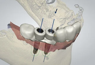 3d планирование имплантации