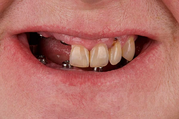 Тотальное восстановление улыбки с помощью имплантации зубов