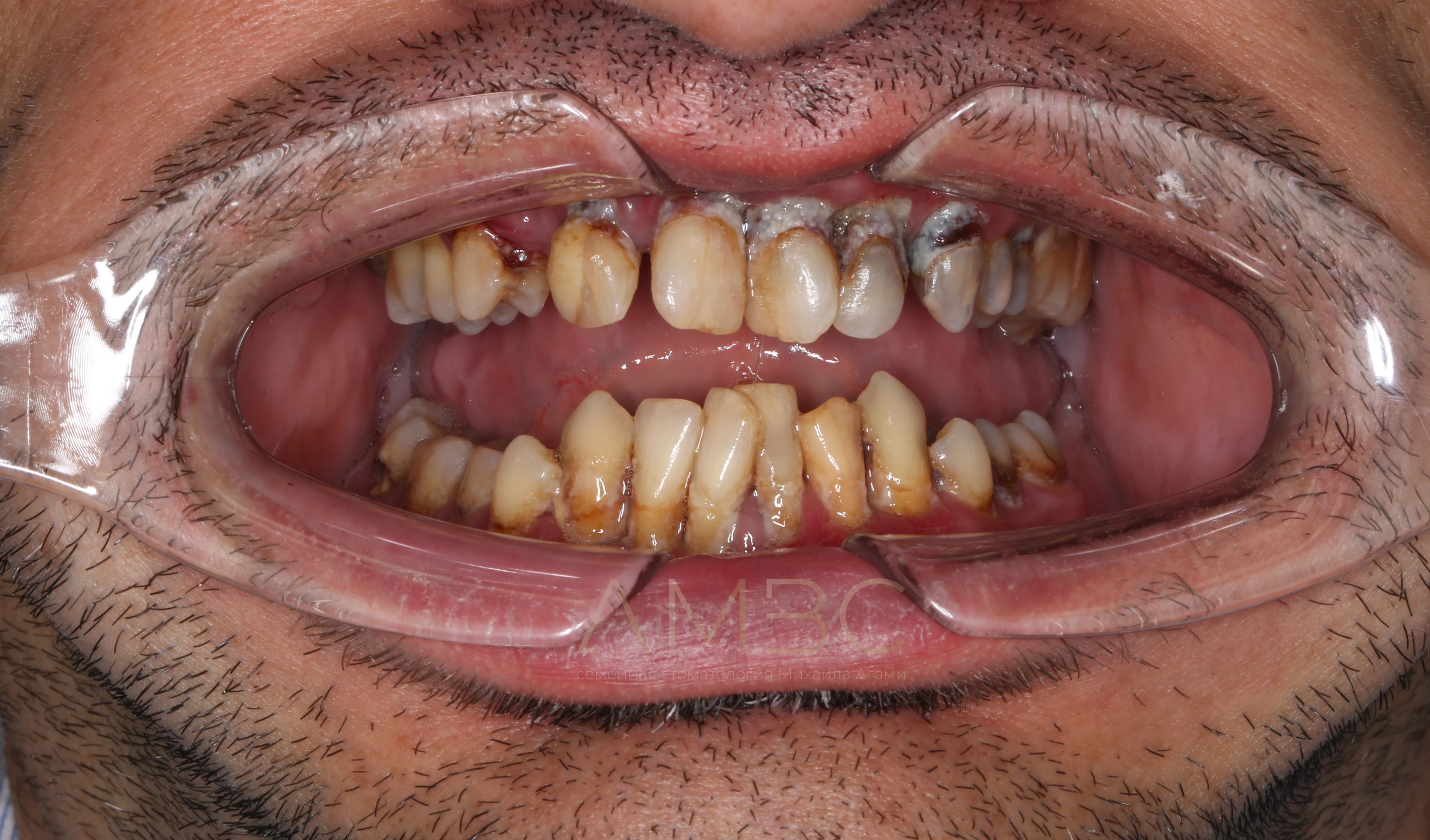 Имплантация и протезирование Имплантация и протезирование