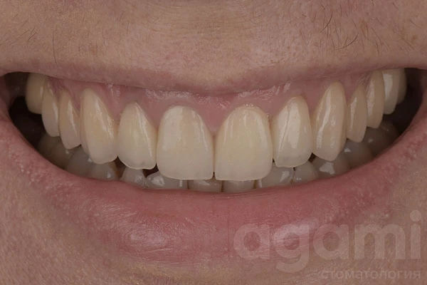 Имплантация и протезирование зубов