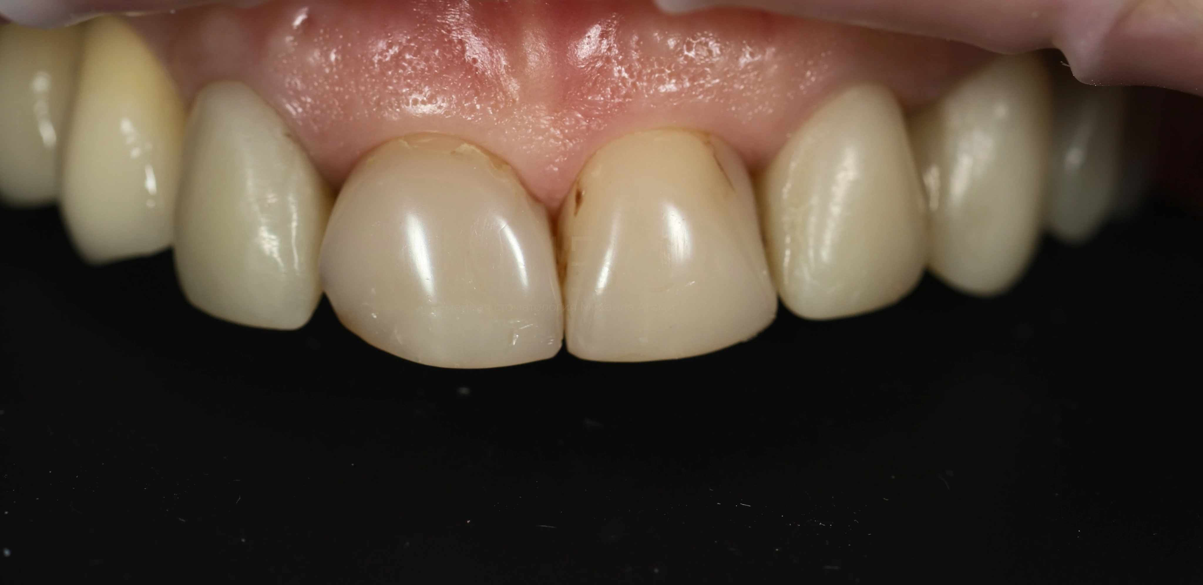 Протезирование зубов