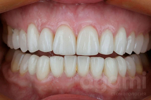 Тотальная функциональная и эстетическая реабилитация улыбки