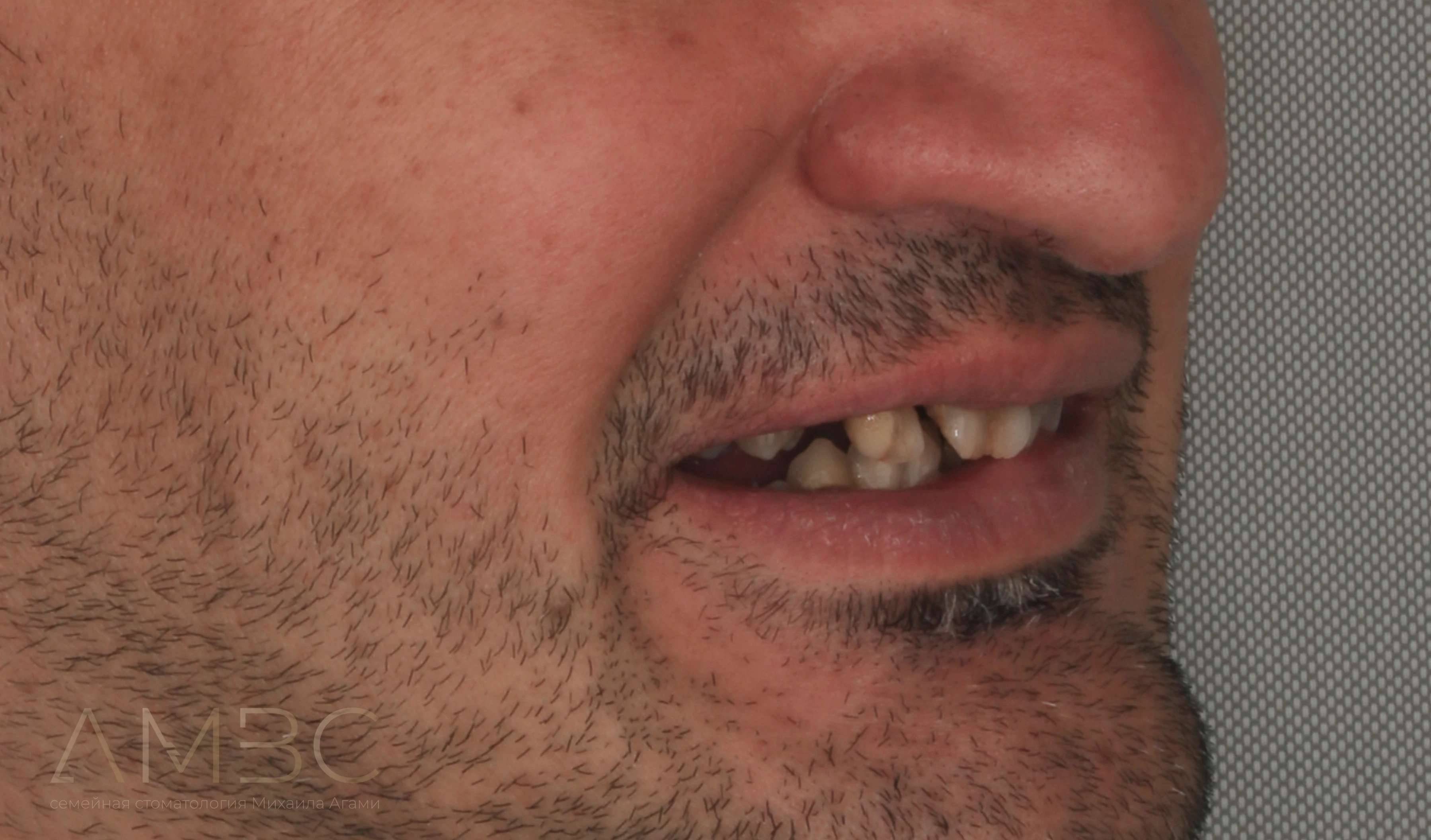 Имплантация и протезирование Имплантация и протезирование