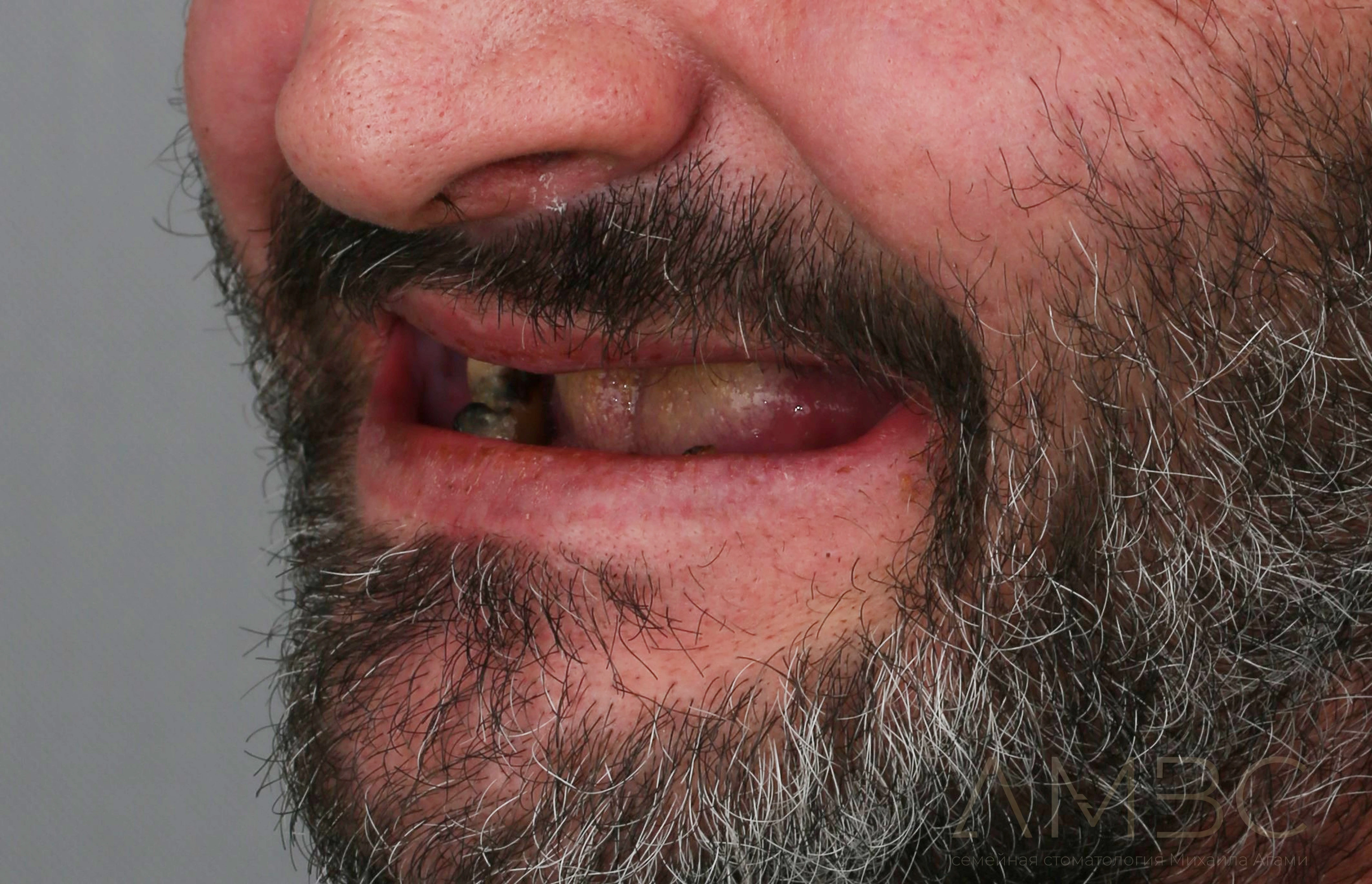 Имплантация и протезирование Имплантация и протезирование