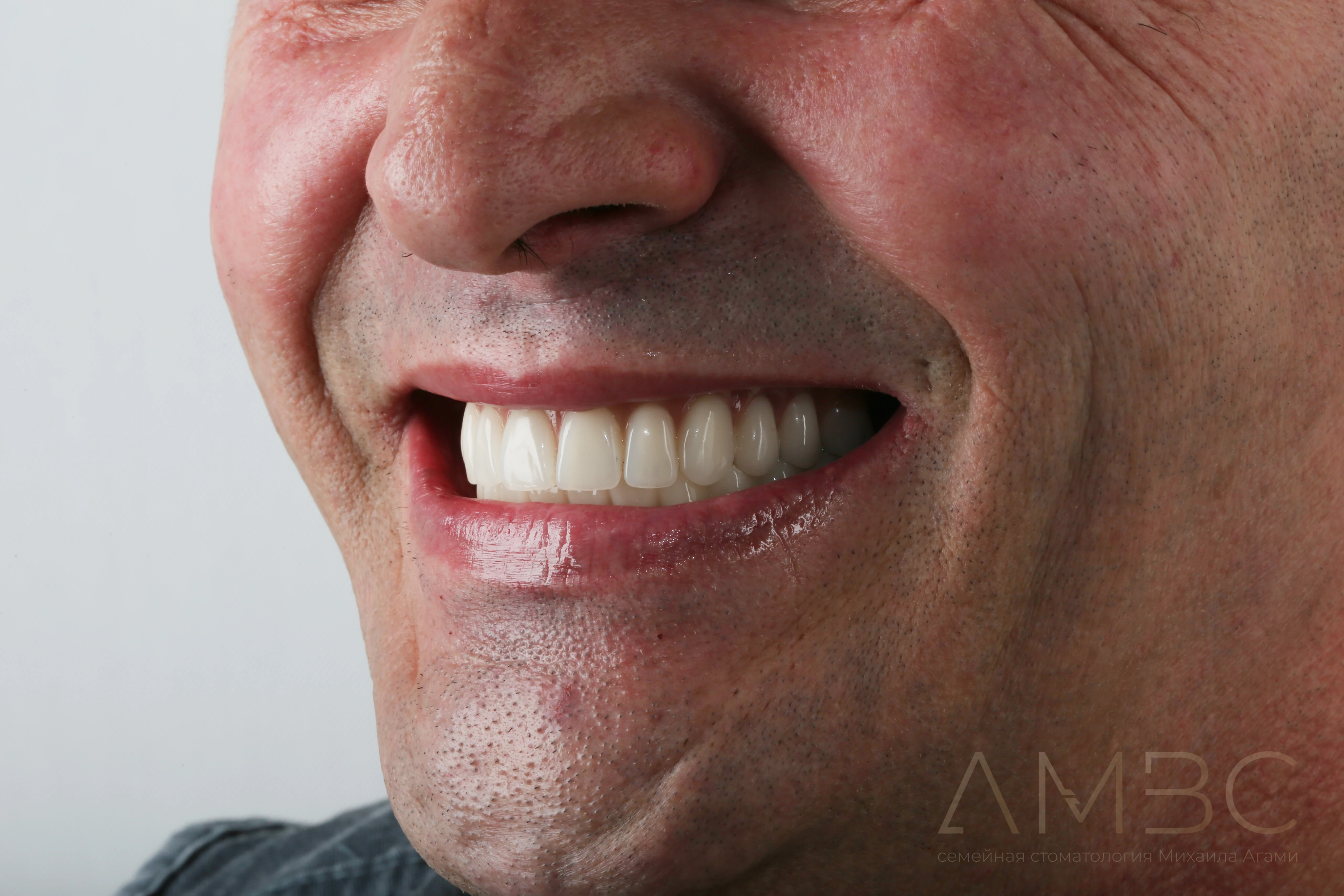 Имплантация и протезирование Имплантация и протезирование