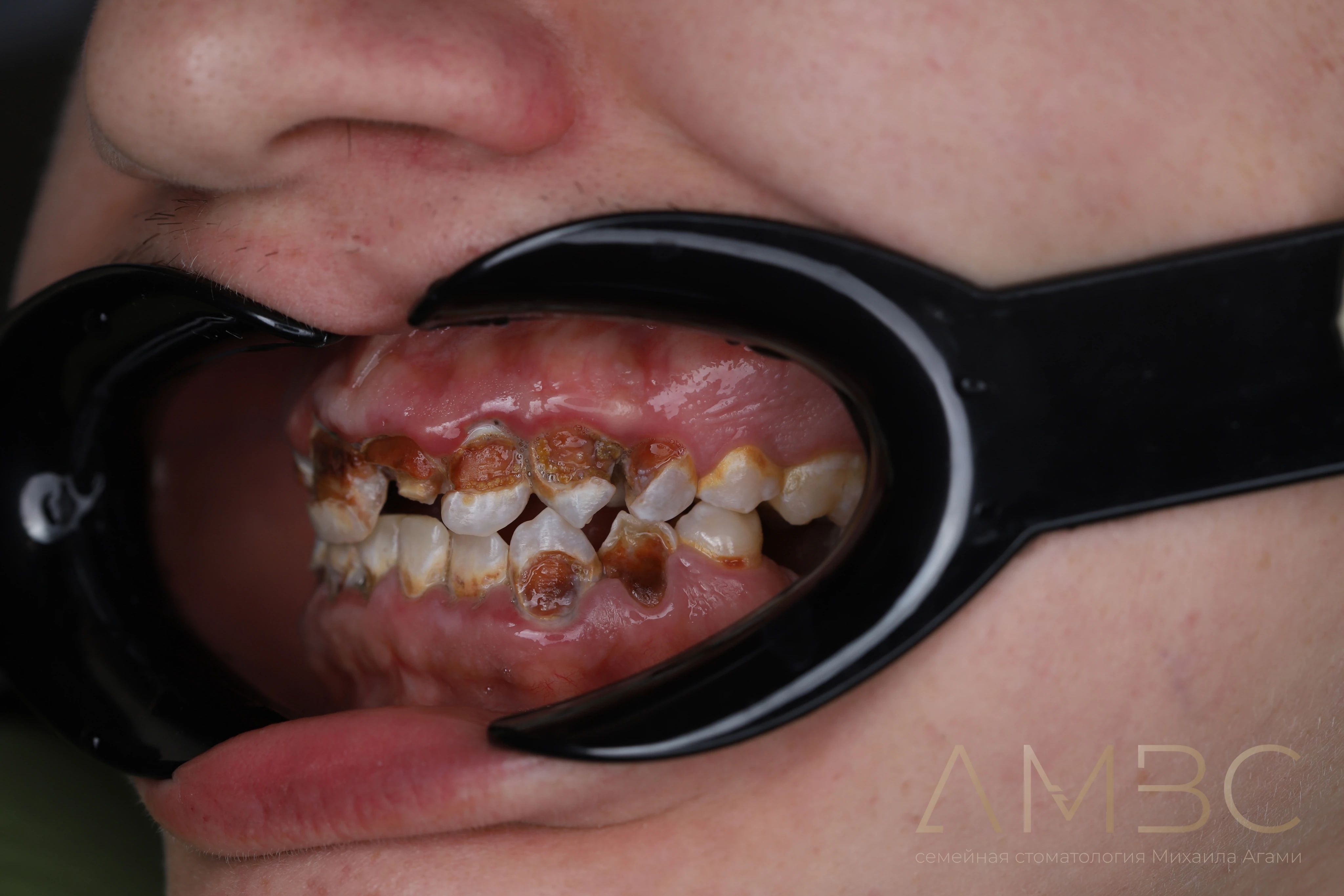 Имплантация и протезирование Имплантация и протезирование