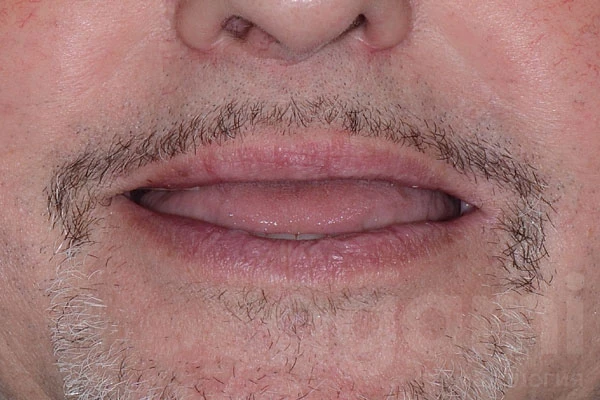 Восстановление зубов верхней и нижней челюсти на имплантатах Восстановление зубов верхней и нижней челюсти на имплантатах