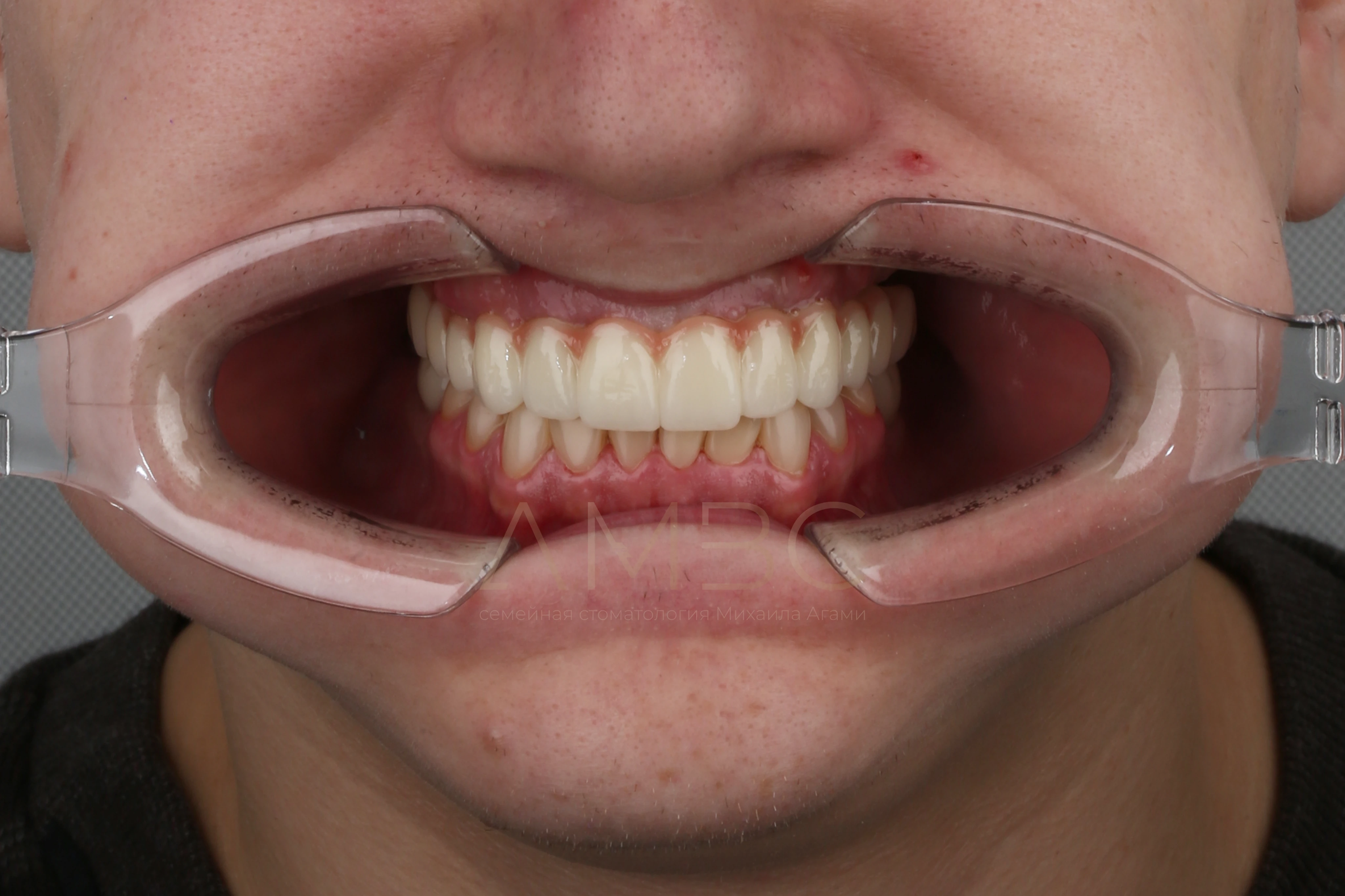 Имплантация и протезирование Имплантация и протезирование