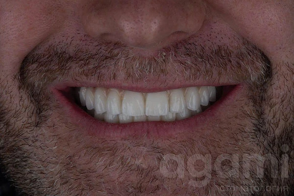 Восстановление зубных рядов Восстановление зубных рядов