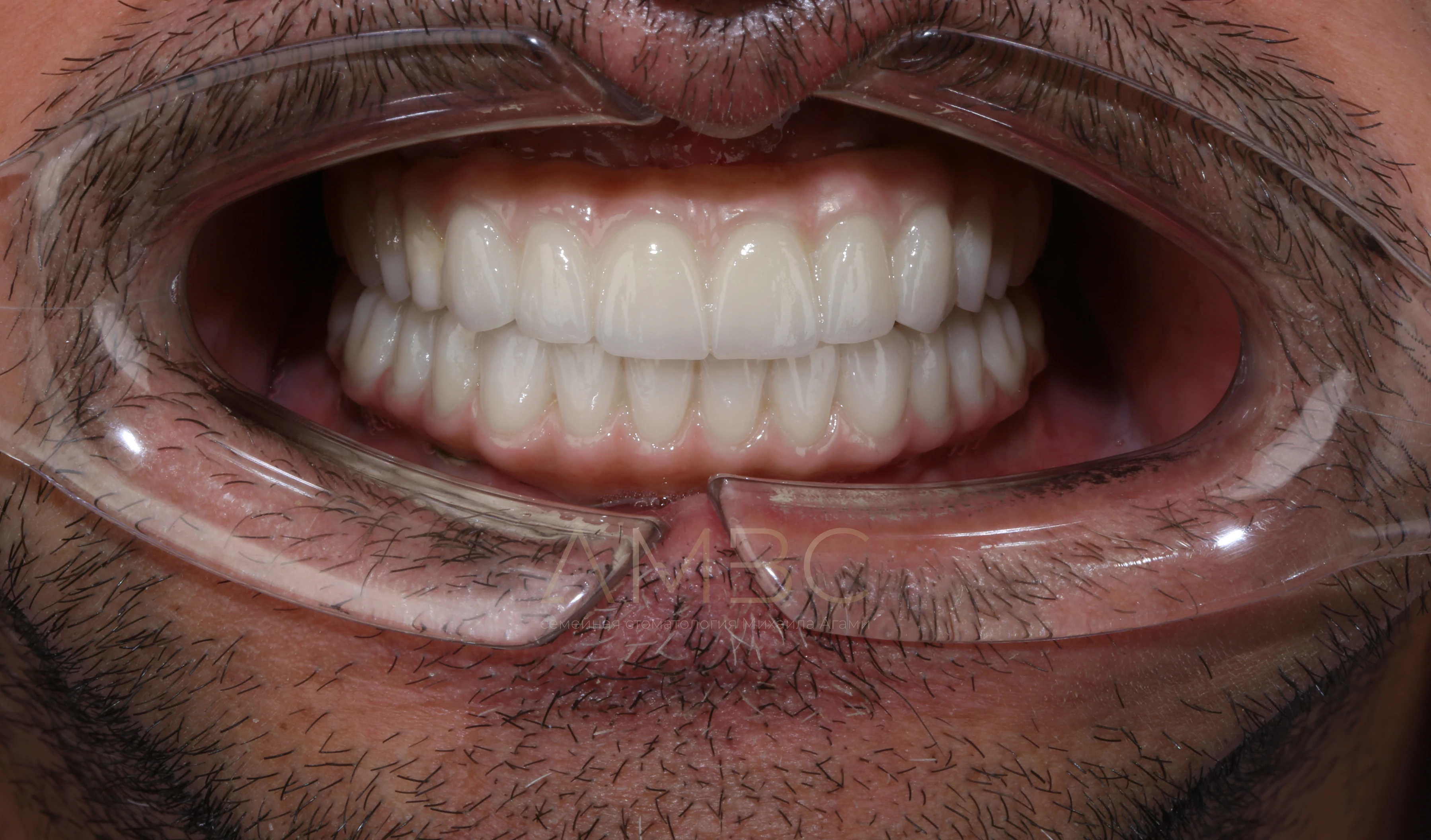 Имплантация и протезирование Имплантация и протезирование