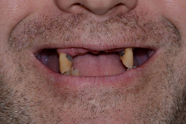 Восстановление зубных рядов Восстановление зубных рядов