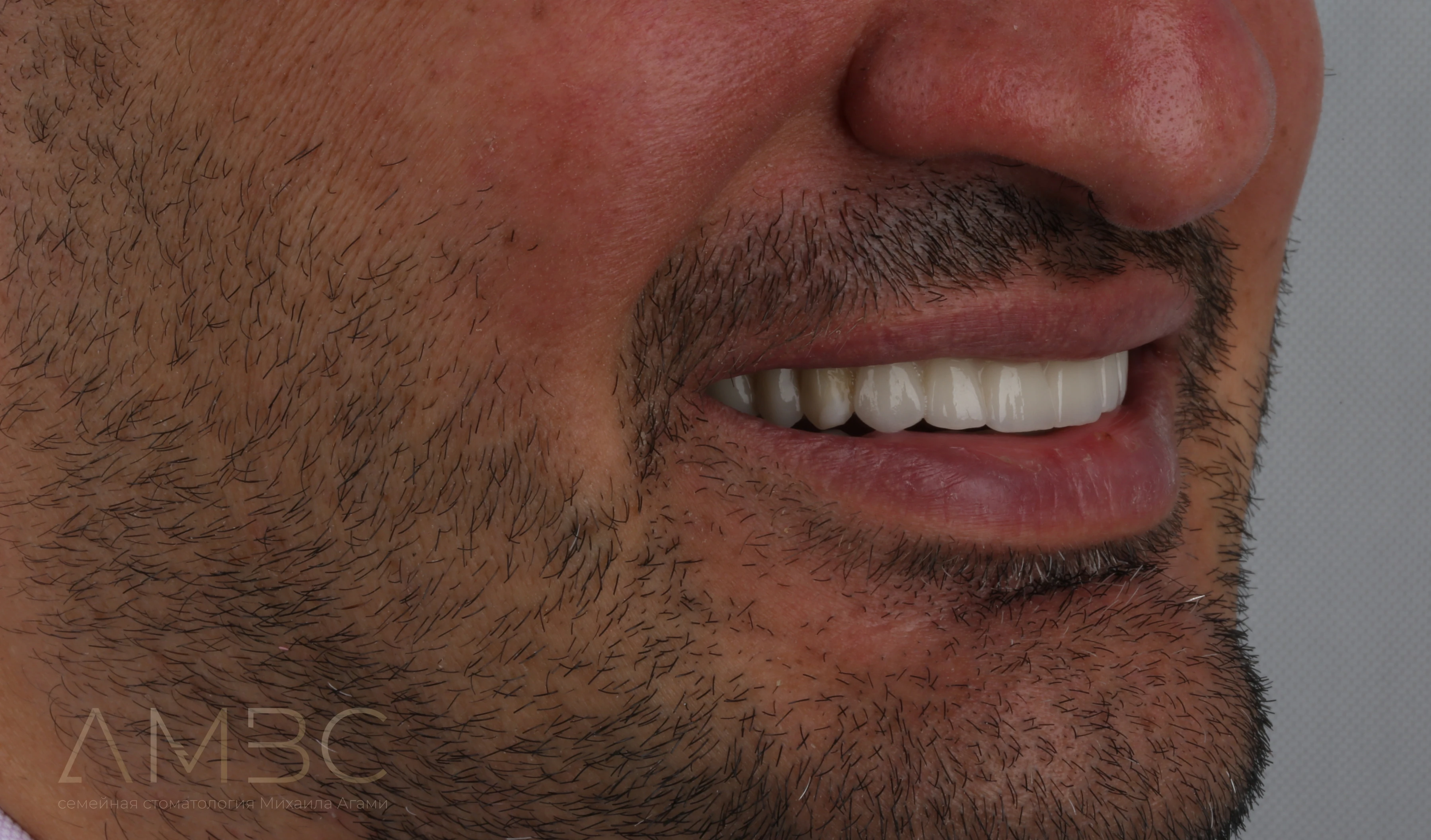 Имплантация и протезирование Имплантация и протезирование